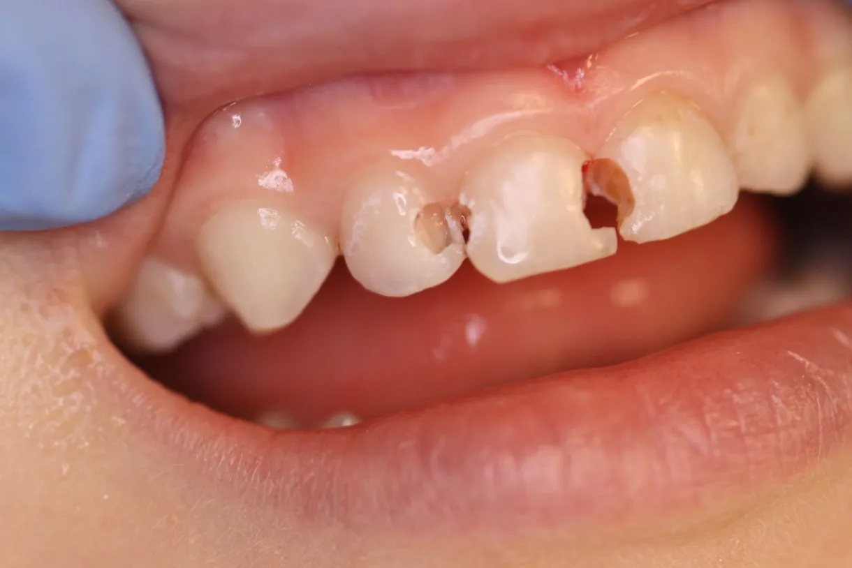 علاج تسوس الأسنان