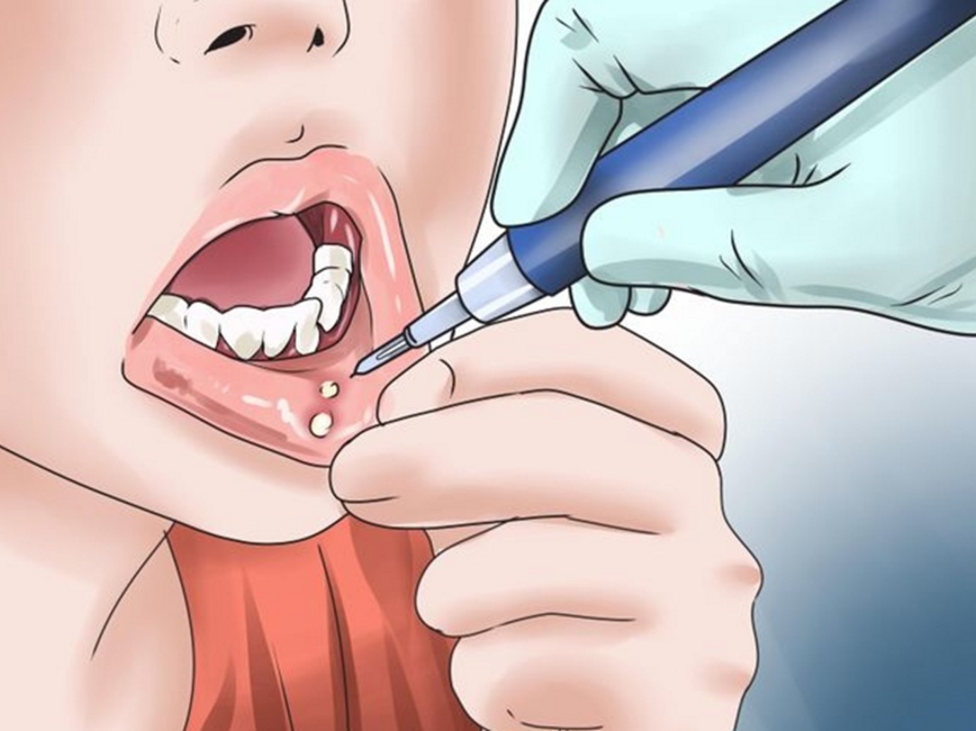 أهم اسباب تقرحات الفم وأعراضها وكيفية علاجها