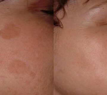 Removing brown spots on the face 360x320