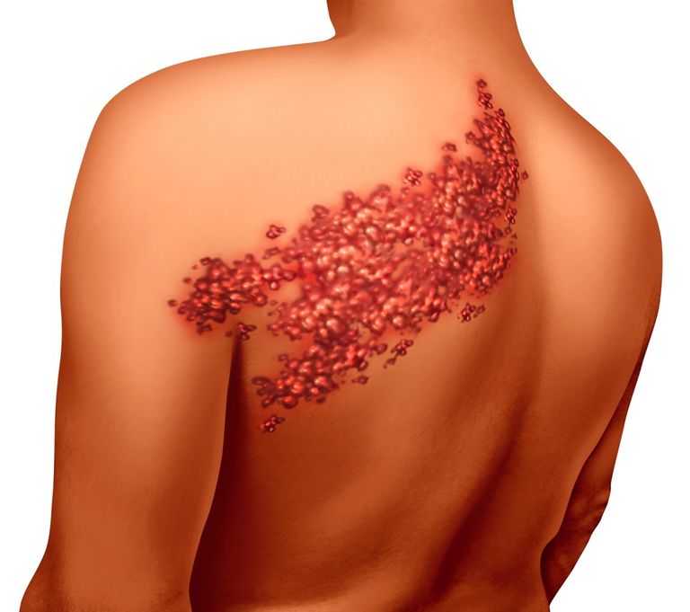 تعرف على الحزام الناري ومخاطره وطرق علاجه